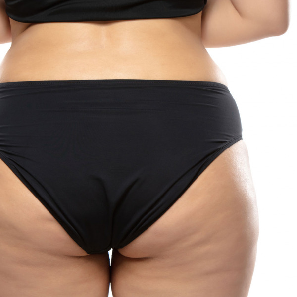 Cellulite nodulosa: cos’è e come trattarla in medicina estetica