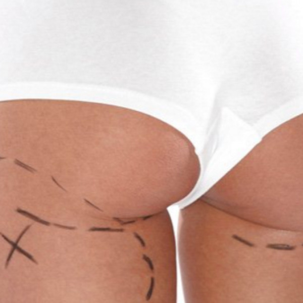 Trattamenti cellulite: setti fibrosi