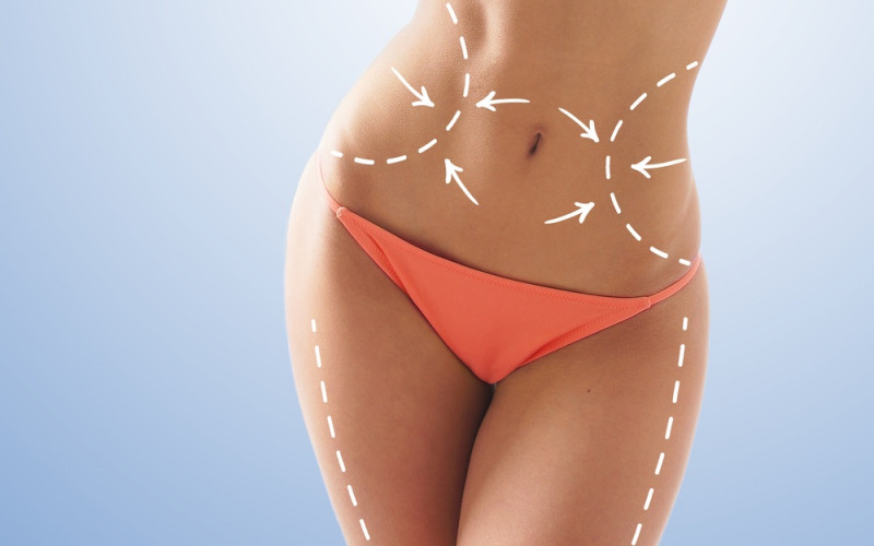 La cavitazione contro grasso e cellulite