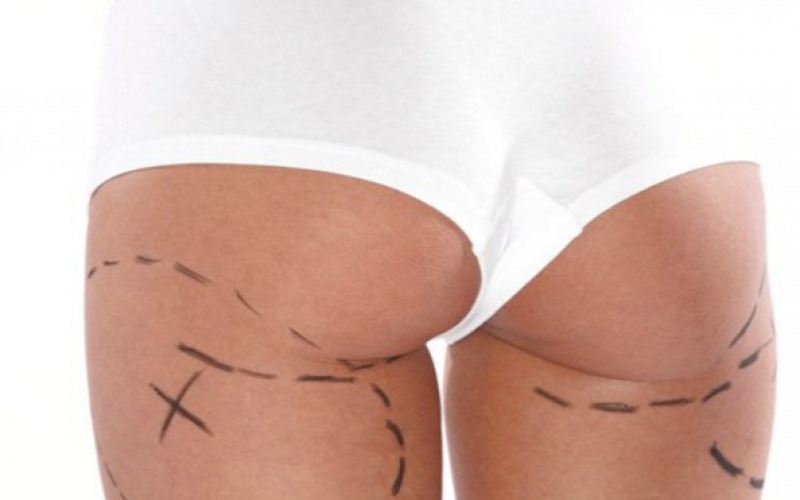 Trattamenti cellulite: setti fibrosi