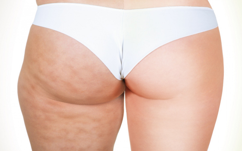 Cellulite sui glutei rimedi